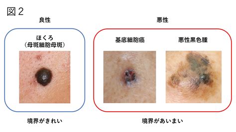 クリトリスほくろについて 